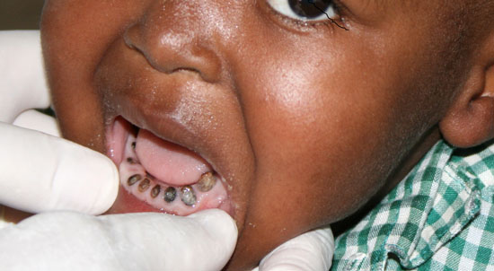 child gum disease
